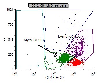 AML (Acute Myelogenous Leukemia Without Maturation) (M1) | Flow Cytometry